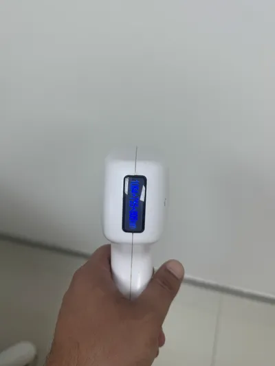 Lazer Epilasyon